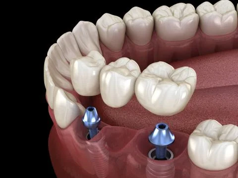 Dental bridge supported by implants. Medically accurate 3D illustration of hu Stock Illustration
