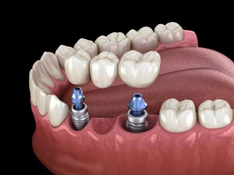 Dental bridge supported by implants. Medically accurate 3D illustration of hu Stock Illustration