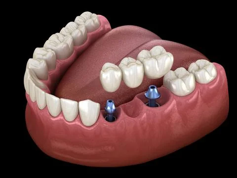 Dental bridge supported by implants. Medically accurate 3D illustration of hu Stock Illustration