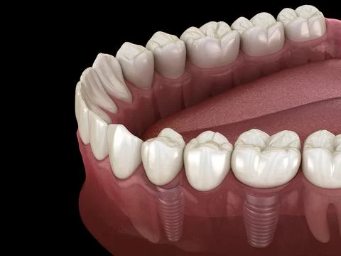 Dental bridge supported by implants. Medically accurate 3D illustration of hu Stock Illustration