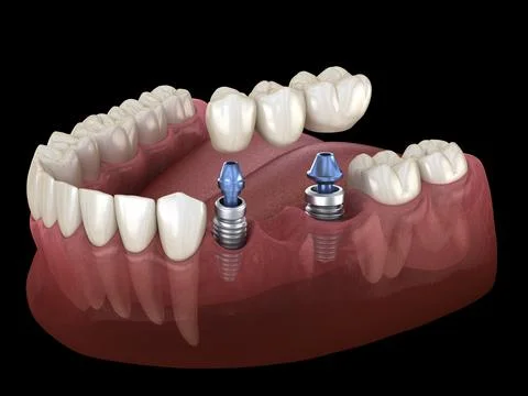 Dental bridge supported by implants. Medically accurate 3D illustration of hu Stock Illustration