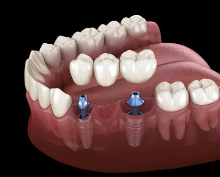 Dental bridge supported by implants. Medically accurate 3D illustration of hu Stock Illustration