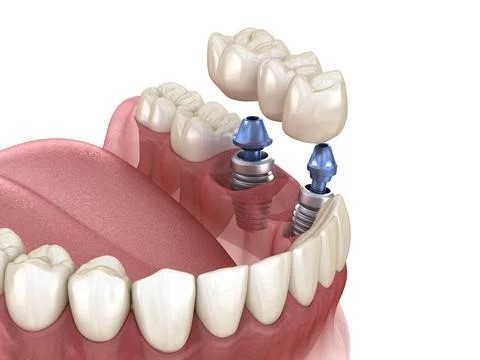 Dental bridge supported by implants. Medically accurate 3D illustration Stock Illustration