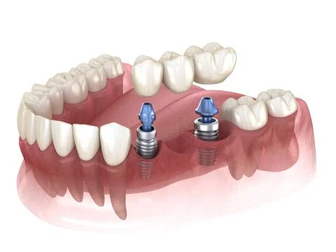 Dental bridge supported by implants. Medically accurate 3D illustration Stock Illustration