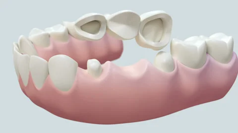 Dental Bridge White 库存影片 38470506