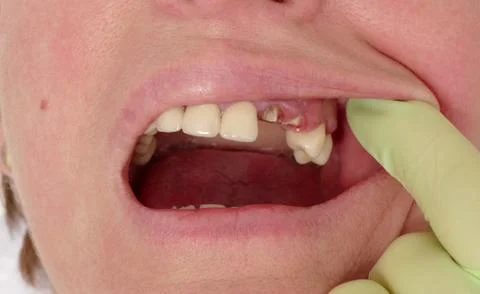 Dental, broken teeth Stockfoto's