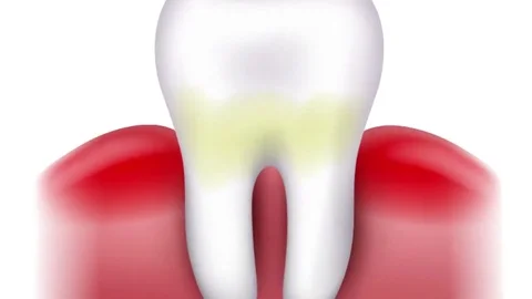 Dental caries formation Stock Footage 69095925