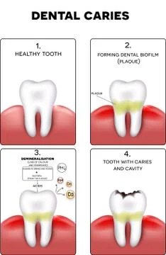 Dental caries formation Stock Illustration