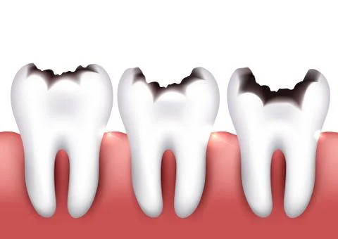 Dental caries Stock Illustration