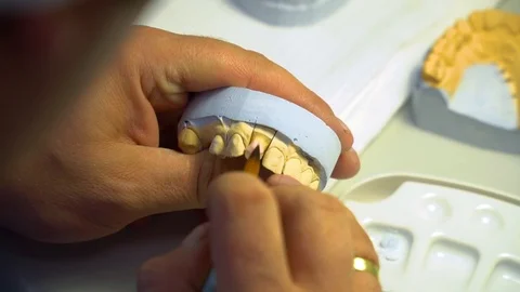 Dental Casting Procedures 스톡 동영상 102219526