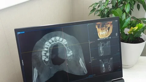 Dental CBCT Diagnostic Software Displaying Multi-View Quadrant Layout on Mo.. Stock Footage 341286127