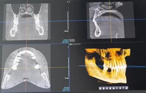 Dental CBCT Imaging Interface with Coronal Sagittal Axial Views and 3D Jaw .. Stock Photos
