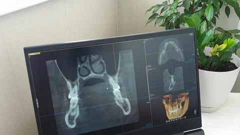 Dental CBCT Interface Showing Coronal Cross Section of Nasal Sinus Cavity. .. Stock Footage 341286578