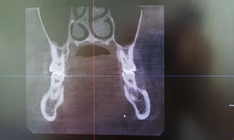 Dental CBCT software interface featuring a 3D volumetric maxillofacial reco.. Stock Photos