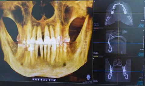 Dental CBCT software interface featuring a 3D volumetric maxillofacial reco.. Stock Photos