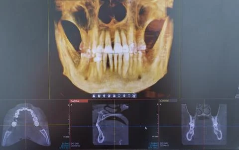 Dental CBCT software interface featuring a 3D volumetric maxillofacial reco.. Stock Photos