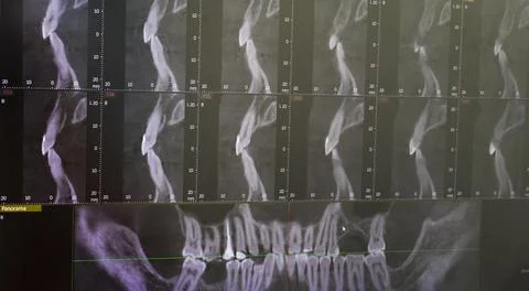 Dental CBCT software interface featuring a 3D volumetric maxillofacial reco.. Stock Photos
