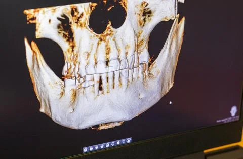 Dental CBCT software interface featuring a 3D volumetric maxillofacial reco.. Stock Photos