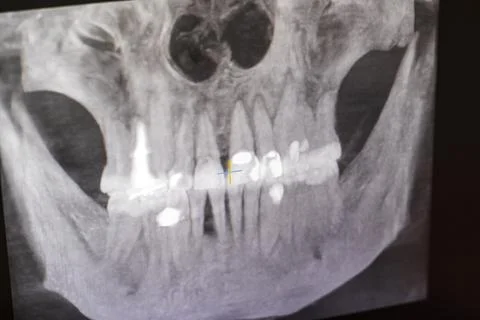 Dental CBCT software interface featuring a 3D volumetric maxillofacial reco.. Stock Photos