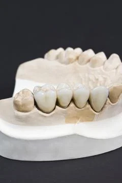 Dental ceramic bridge Stock Photos