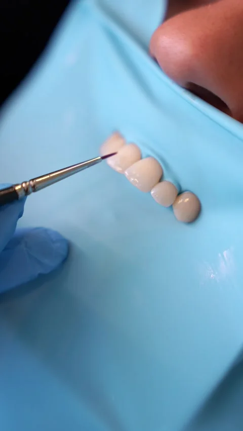 Dental Ceramics Application in Lab Stock Footage 331163498
