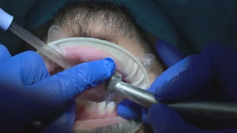 Dental Cleaning Procedure Video stock 316913580