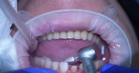 Dental Cleaning Process Video stock 316917239