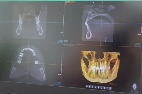 Dental cone beam computed tomography or CBCT diagnostic scan software displ.. Stock Photos