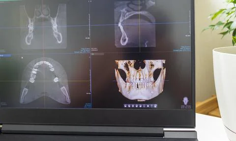 Dental cone beam computed tomography or CBCT diagnostic scan software displ.. Stock Photos