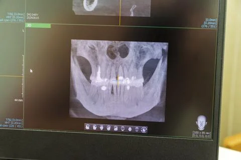 Dental cone beam computed tomography or CBCT diagnostic scan software displ.. Stock Photos