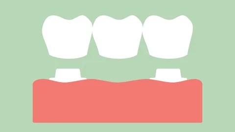 Dental crown with bridge, installation process and change of teeth Stock Footage 105338231