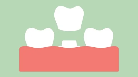 Dental crown, installation process and change of teeth Stock Footage 105337801