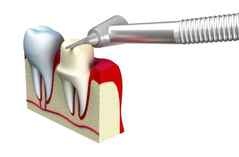 Dental crown installation process, isolated on white Stock Illustration
