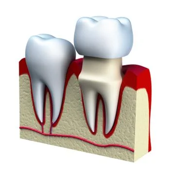 Dental crown installation process, isolated on white Ilustração Stock