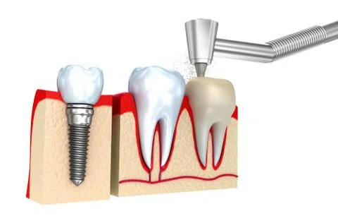 Dental crown installation process, isolated on white Stock Illustration