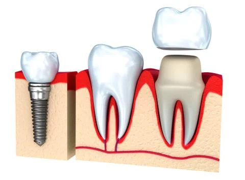 Dental crown installation process, isolated on white Illustrazione stock