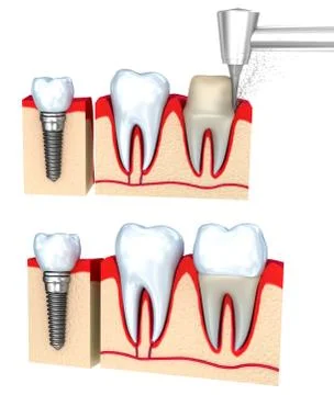 Dental crown installation process, isolated on white Illustrazione stock