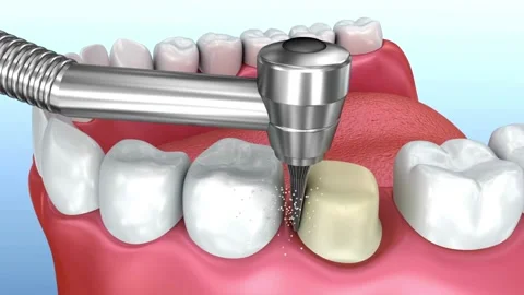 Dental Crown Preparation: Tooth Reshaping with Dental Drill Stock Footage 327665772