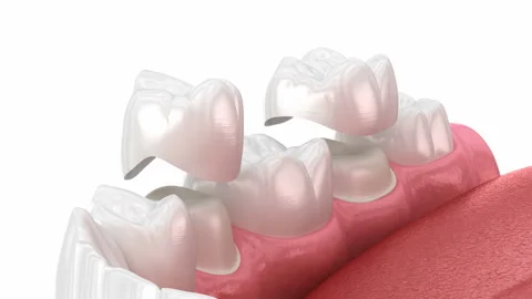 Dental crowns placement over teeth. Dental 3D animation Stock Footage 239234345