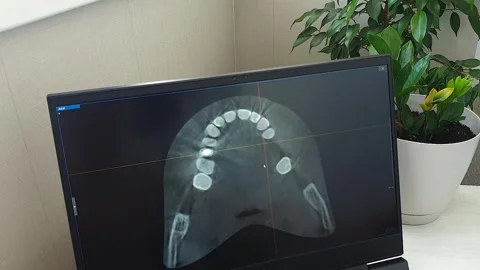 Dental CT Scan Axial Slice View of Dental Arch on Monitor Screen. Dental Stock Footage 341285852