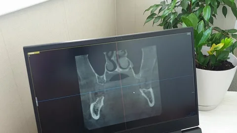 Dental CT Scan Coronal Slice View on Monitor for Oral Surgery Planning. Denta Stock Footage 341284674