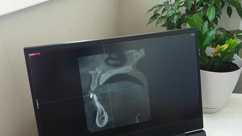 Dental CT Scan Sagittal Slice View on Monitor Screen. Dental Stock Footage 341285236