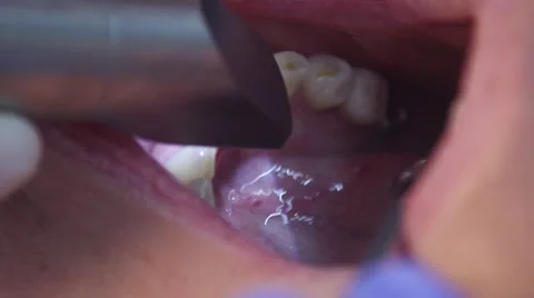 Dental digital scanning Stock Footage 61156079