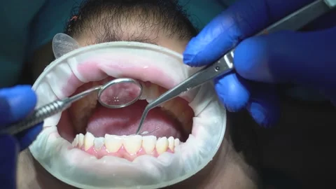 Dental Examination Procedure Stock Footage 316913324