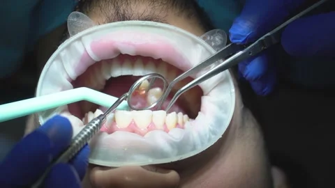 Dental Examination Procedure Stock Footage 316914234