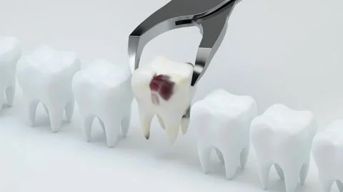 Dental extraction motion of decayed tooth being removed by forceps from a r.. Stock Footage 332151788