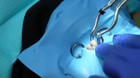 Dental Extraction Procedure Stock Footage 316916271