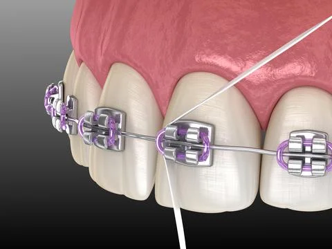Dental floss cleaning braces process. Medically accurate 3D illustration Stock Illustration