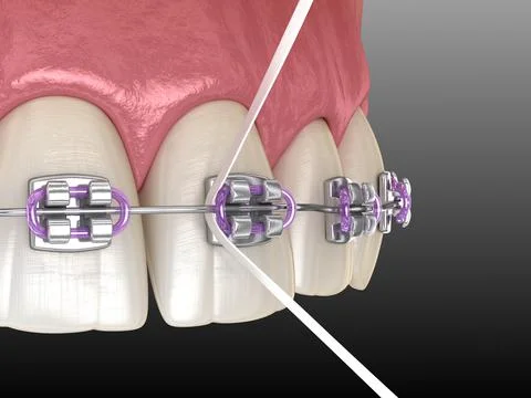 Dental floss cleaning braces process. Medically accurate 3D illustration Stock Illustration