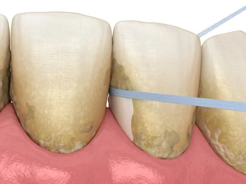 Dental floss cleaning process. Medically accurate 3D illustration Stock Illustration